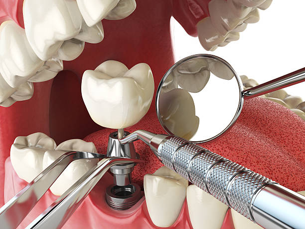 Best Emergency Wisdom Teeth Removal in Granite Falls, NC